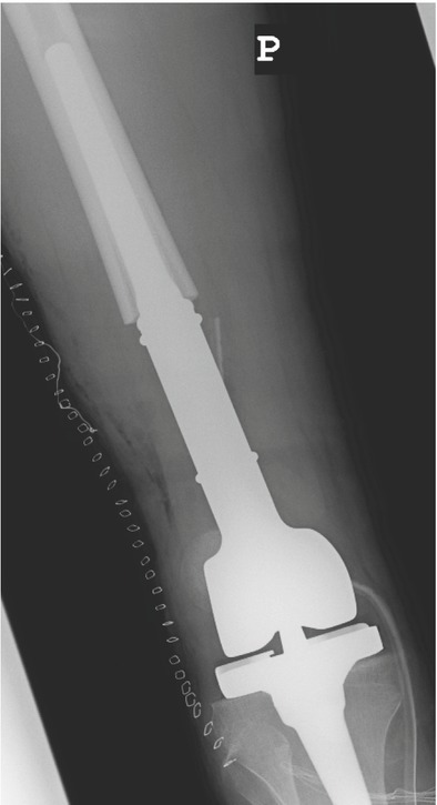 Suspicion of Recurrent Osteosarcoma in a Patient with Pseudotumour Adjacent To the Endoprosthesis.