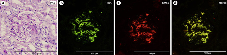 KM55 in the Evaluation of IgA-Containing Glomerular Diseases.