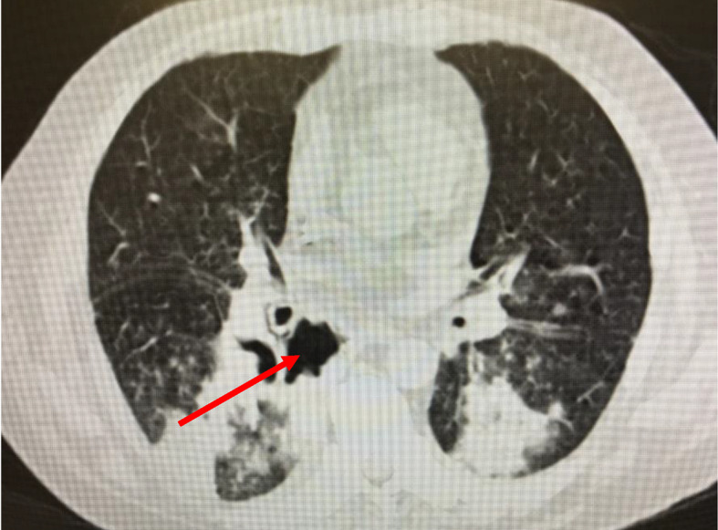 [Pulmonary cavitations, late complication of COVID-19].