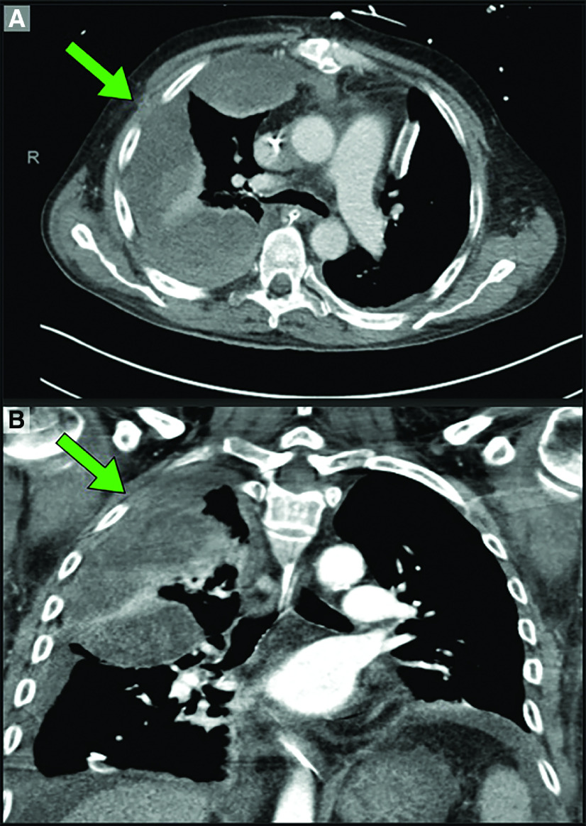 Video-Assisted Thoracoscopic Surgery Management of Subacute Retained Blood Syndrome after Cardiac Surgery.