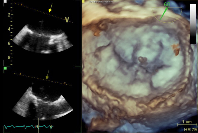 [Drop in oxygen saturation and blood pressure as well as increase in central venous pressure during mitral valve clipping in an 81-year-old female patient].