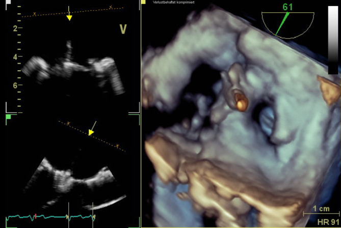 [Drop in oxygen saturation and blood pressure as well as increase in central venous pressure during mitral valve clipping in an 81-year-old female patient].