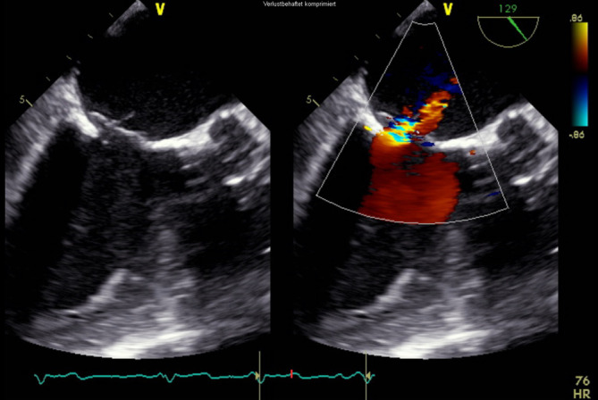 [Drop in oxygen saturation and blood pressure as well as increase in central venous pressure during mitral valve clipping in an 81-year-old female patient].