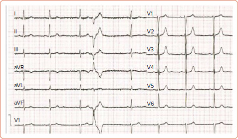 Arrhythmogenic Mitral Valve Prolapse.