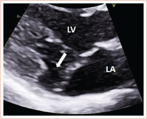Arrhythmogenic Mitral Valve Prolapse.