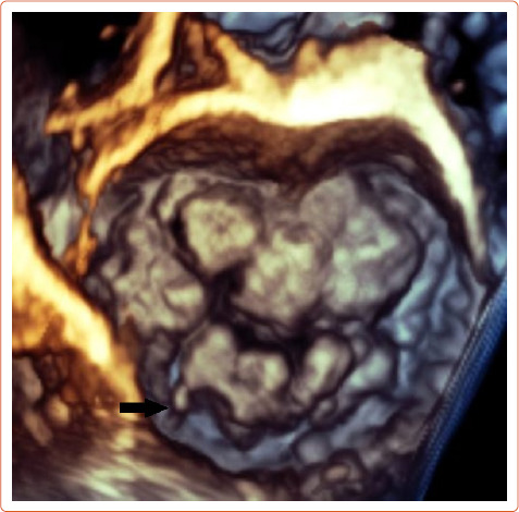 Arrhythmogenic Mitral Valve Prolapse.