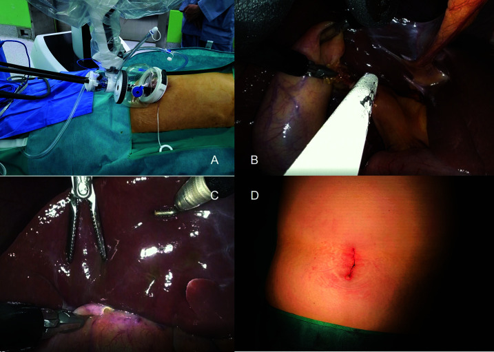 Feasibility and Efficacy of Single-Port Robotic Cholecystectomy Using the da Vinci SP® Platform.