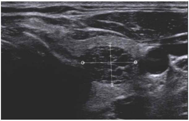 Summary of Meta-analyses of Studies Involving TIRADS Classifications (EU-TIRADS, ACR-TIRADS, and K-TIRADS) in Evaluating the Malignant Potential of Focal Lesions of The Thyroid Gland.