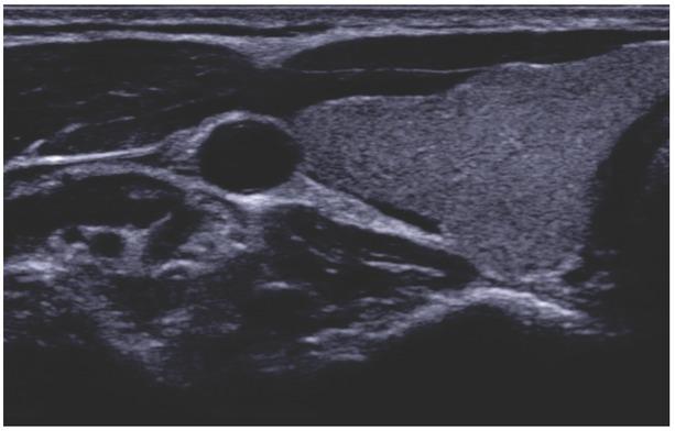 Summary of Meta-analyses of Studies Involving TIRADS Classifications (EU-TIRADS, ACR-TIRADS, and K-TIRADS) in Evaluating the Malignant Potential of Focal Lesions of The Thyroid Gland.