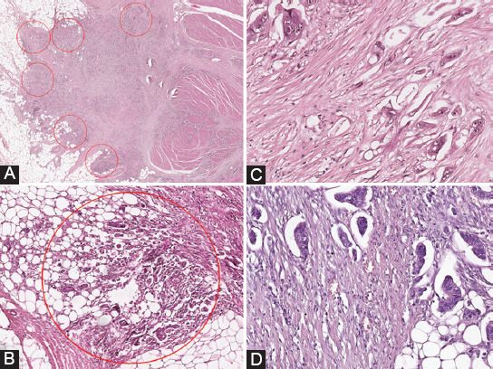 Poorly differentiated clusters and tumor budding are important prognostic factors in colorectal carcinomas.