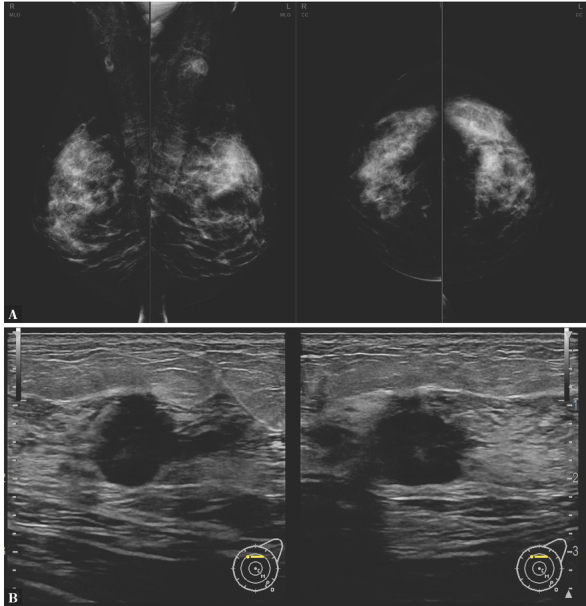 The Role of ABUS in The Diagnosis of Breast Cancer.