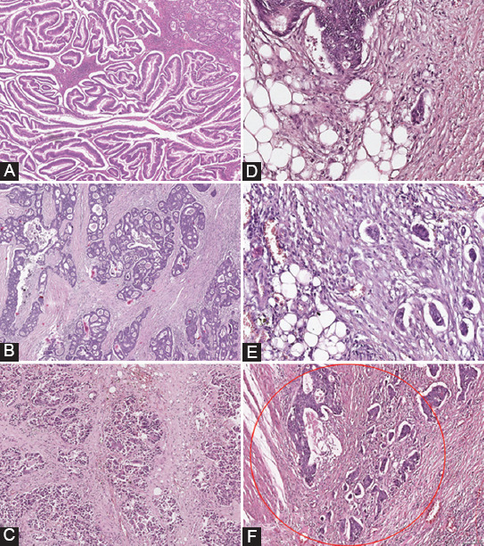 Poorly differentiated clusters and tumor budding are important prognostic factors in colorectal carcinomas.