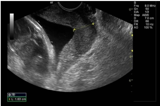 Prediction of Preterm Birth with Serial Measurements of Ultrasound Markers.