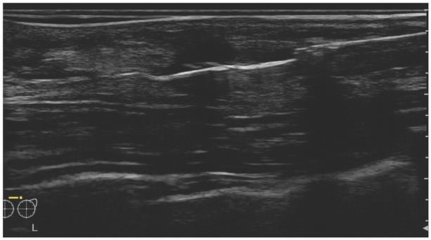 The Role of ABUS in The Diagnosis of Breast Cancer.