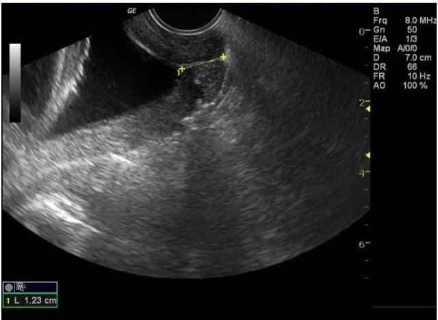 Prediction of Preterm Birth with Serial Measurements of Ultrasound Markers.