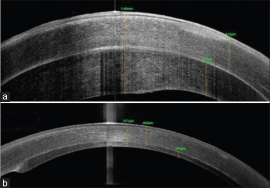 "Separate the Wheat from the Chaff" - Descemet's Stripping Endothelial Keratoplasty Graft Failure due to Accidental Implantation of Full-Thickness Precut Tissue.