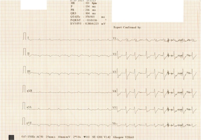 Reverse Takotsubo Cardiomyopathy after Orthotopic Liver Transplantation. A Case Report.