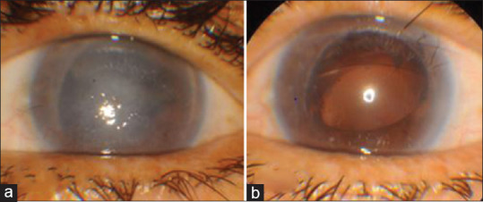 "Separate the Wheat from the Chaff" - Descemet's Stripping Endothelial Keratoplasty Graft Failure due to Accidental Implantation of Full-Thickness Precut Tissue.