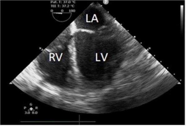 Reverse Takotsubo Cardiomyopathy after Orthotopic Liver Transplantation. A Case Report.