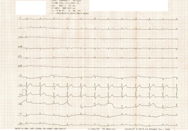 Reverse Takotsubo Cardiomyopathy after Orthotopic Liver Transplantation. A Case Report.