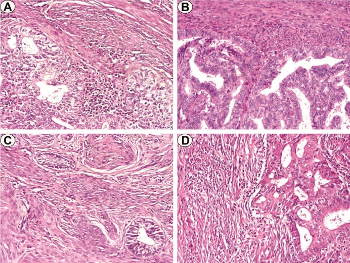 Clinicopathological Prognostic Parameters of Endometrioid Endometrial Carcinomas.