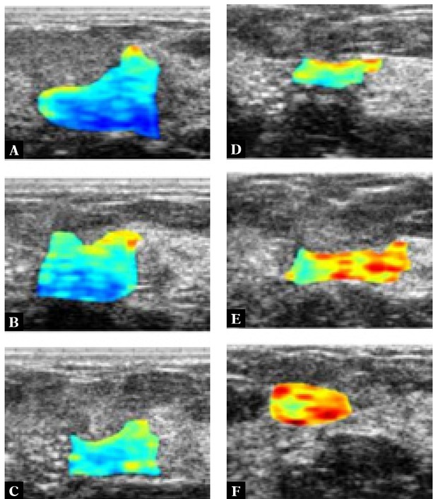 Quantitative Ultrasonography as a Tool for the Evaluation of Breast Tumor Response to Neoadjuvant Chemotherapy.