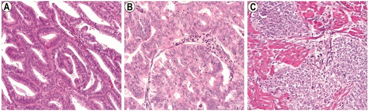 Clinicopathological Prognostic Parameters of Endometrioid Endometrial Carcinomas.