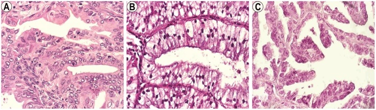 Clinicopathological Prognostic Parameters of Endometrioid Endometrial Carcinomas.