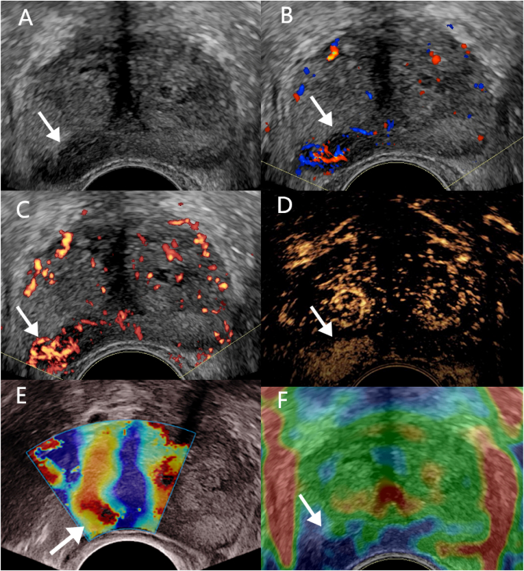 Recent advances of multimoda ultrasound in image-guided prostate-targeted biopsy