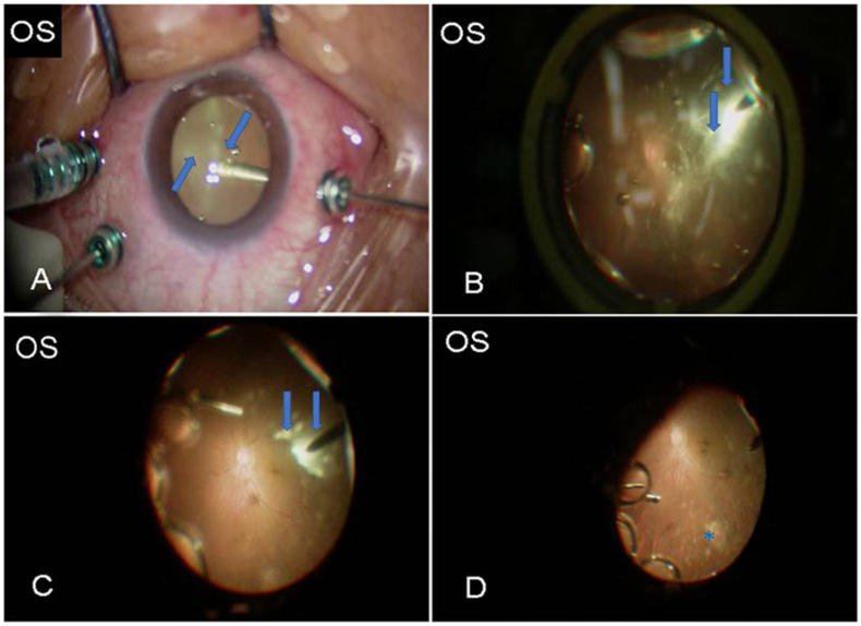 Sarcoid uveitis: A case report and systematic review of literature