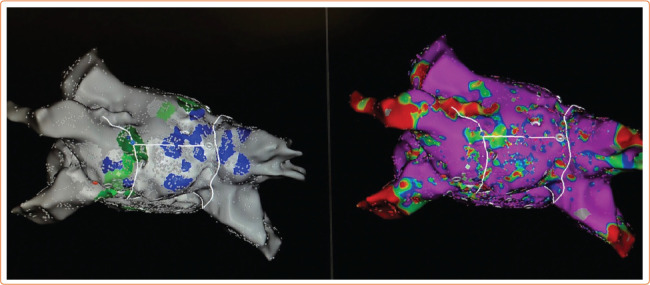 Future Directions for Mapping Atrial Fibrillation.