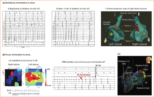 Future Directions for Mapping Atrial Fibrillation.