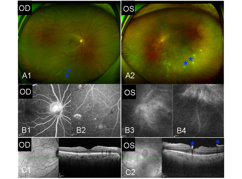 Sarcoid uveitis: A case report and systematic review of literature