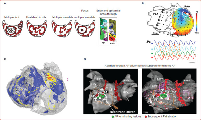 Future Directions for Mapping Atrial Fibrillation.