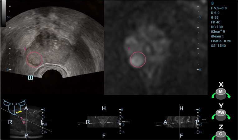 Recent advances of multimoda ultrasound in image-guided prostate-targeted biopsy