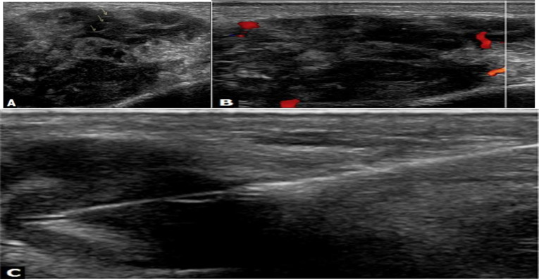 The Diagnostic Value of Ultrasound-Guided Cervical Core Needle Biopsy in Diagnosis of Lymphoma in Suspected Patients.