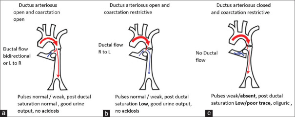 Anesthetic Management of a Neonate with Coarctation of the Aorta and Duct-Dependent Circulation Posted for Tracheoesophageal Fistula Repair.