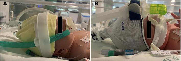 Rotating nasal masks with nasal prongs reduces the incidence of moderate to severe nasal injury in preterm infants supported by noninvasive ventilation.