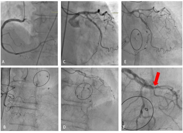 Severe Coronary Artery Vasospasm after Mitral Valve Replacement in a Diabetic Patient with Previous Stent Implantation: A Case Report.