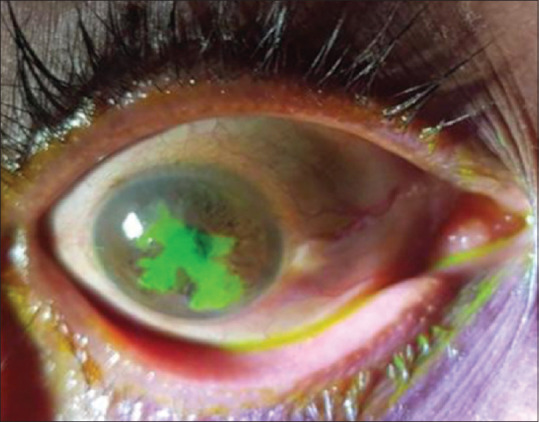 Acute Onset Flaccid Paraplegia with Monocular Diminution of Vision in a Case of Chikungunya Infection.