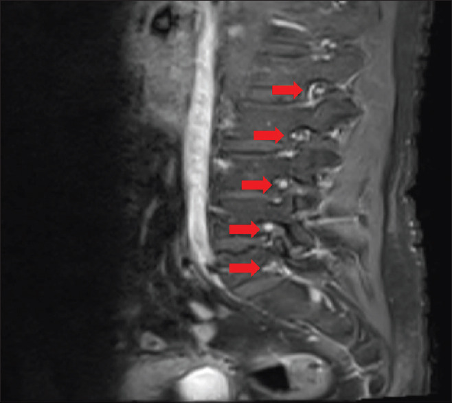 Acute Onset Flaccid Paraplegia with Monocular Diminution of Vision in a Case of Chikungunya Infection.