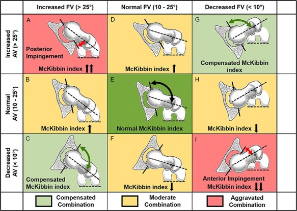 Combined abnormalities of femoral version and acetabular version and McKibbin Index in FAI patients evaluated for hip preservation surgery.