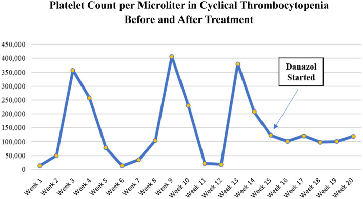 Cyclical Thrombocytopenia Synchronized With the Patient's Menstrual Cycle Treated With Danazol.