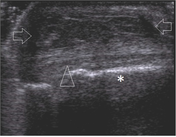 Ultrasound-guided Biopsy of Musculoskeletal Soft-tissue Tumors: Basic Principles, Usefulness and Limitations.