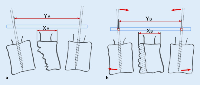 [Local spinal profile following operative treatment of thoracolumbar and lumbar fractures : Impact of reduction technique and bone quality].