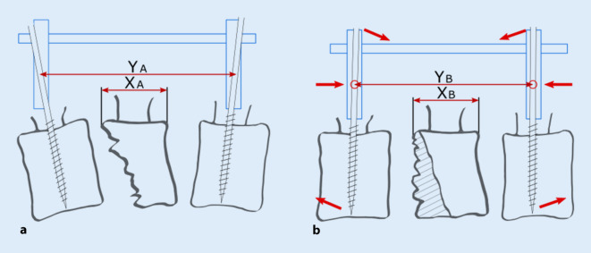 [Local spinal profile following operative treatment of thoracolumbar and lumbar fractures : Impact of reduction technique and bone quality].