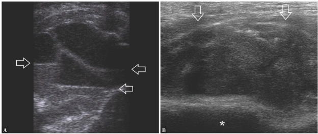 Ultrasound-guided Biopsy of Musculoskeletal Soft-tissue Tumors: Basic Principles, Usefulness and Limitations.