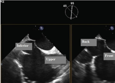 2019 Chinese expert consensus statement on left atrial appendage closure in patients with atrial fibrillation.
