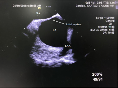 2019 Chinese expert consensus statement on left atrial appendage closure in patients with atrial fibrillation.