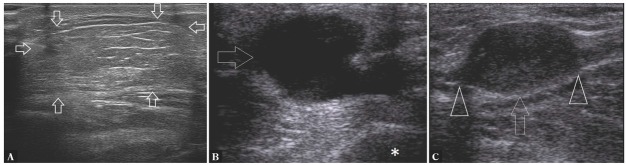 Ultrasound-guided Biopsy of Musculoskeletal Soft-tissue Tumors: Basic Principles, Usefulness and Limitations.